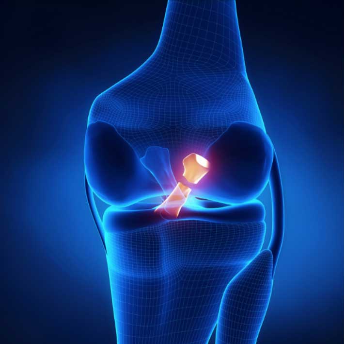 Anterior Cruciate Ligament Injury, ACL Tear, Knee Doctor
