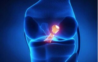 ACL Tear | Manhattan NY