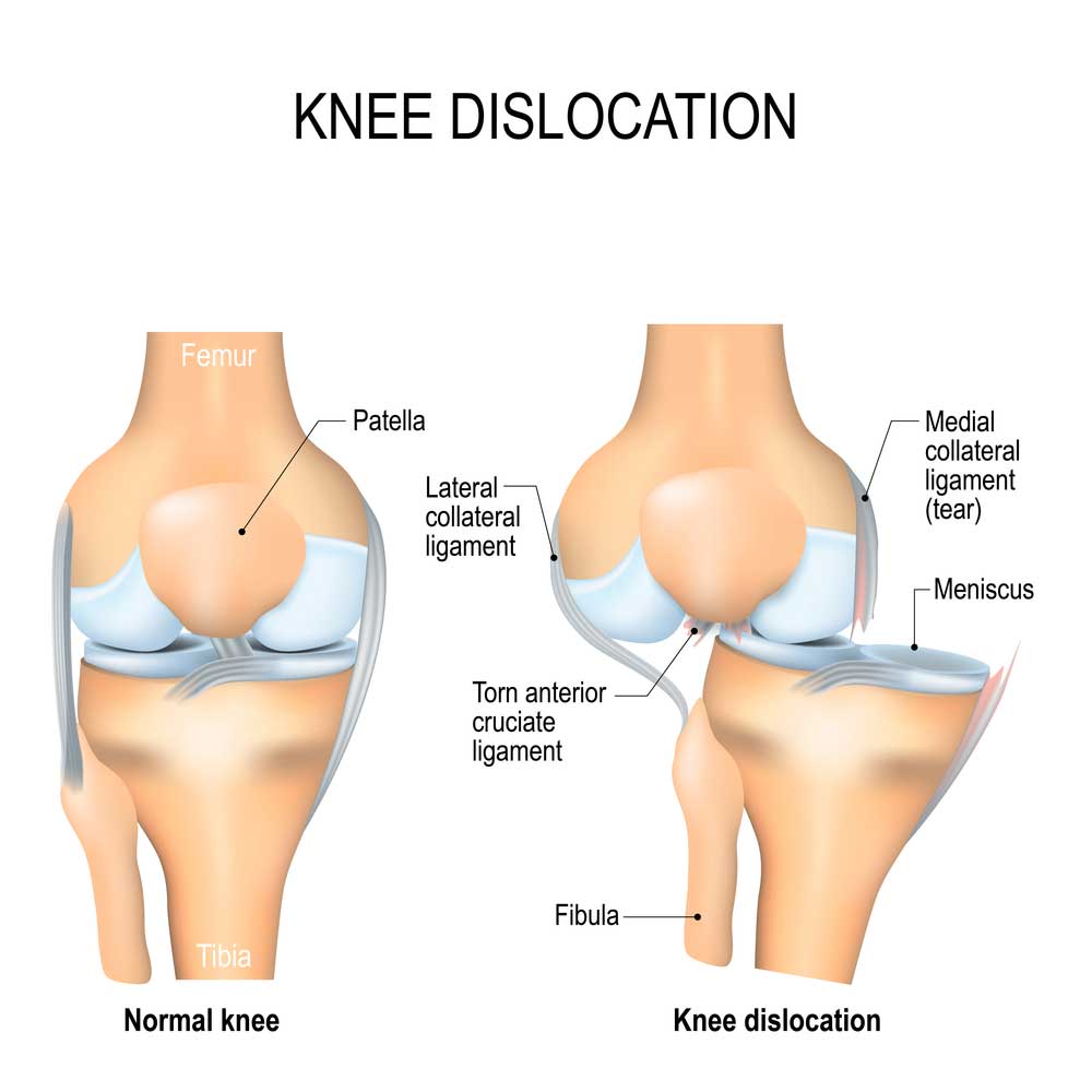 Posterior deals knee dislocation