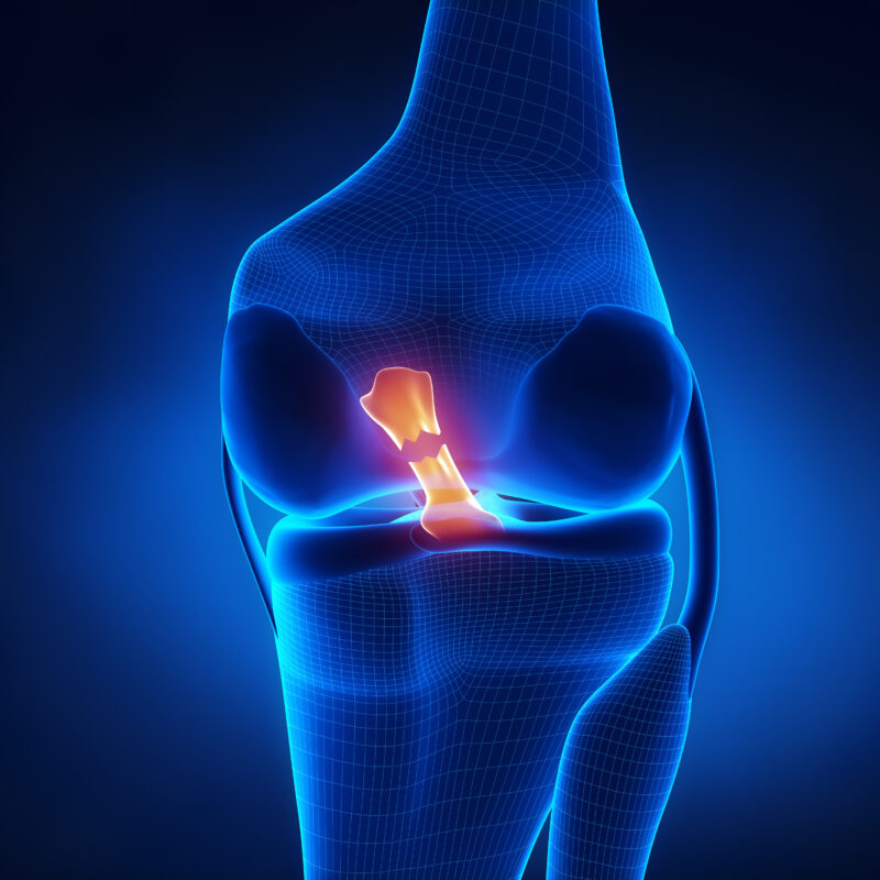 swollen-knee-from-torn-ligament-stock-image-c013-5890-science