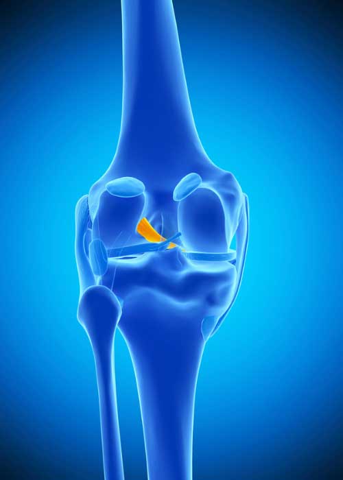 ACL Insufficiency | Anterior Knee Instability | Knee Instability |  Orthopedic Knee Specialist | Manhattan, Brooklyn, New York City NY