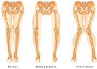 Miserable Malalignment Syndrome |Knee Malalignment Syndrome |Orthopedic ...