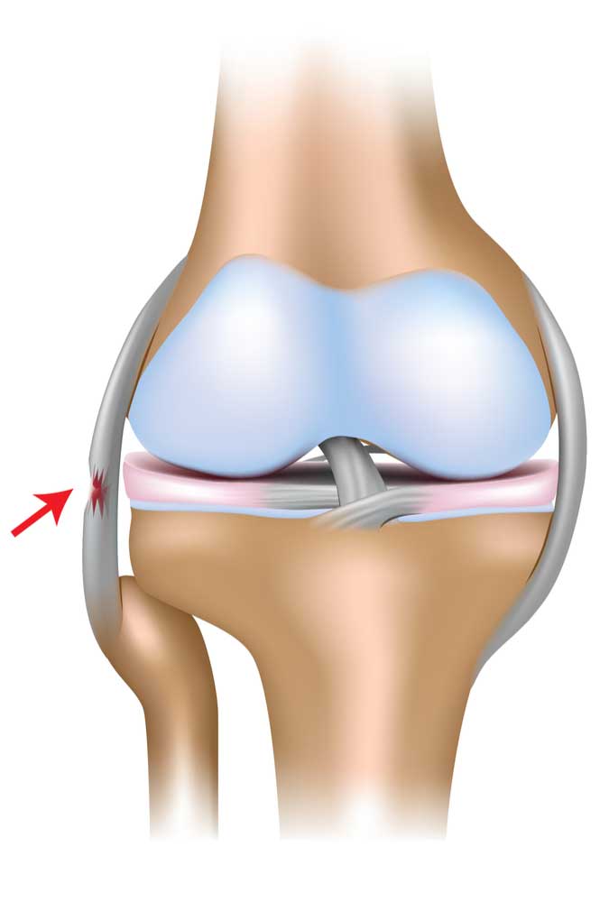 lateral collateral ligament