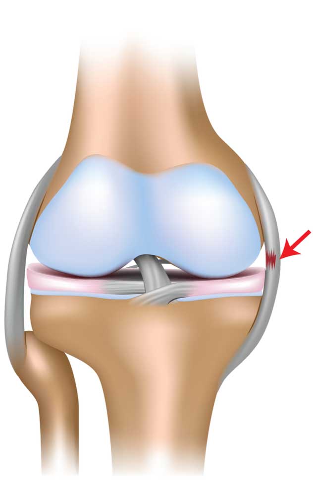 MCL Tear, MCL Injury, MCL Insufficiency, Orthopedic Knee Specialist
