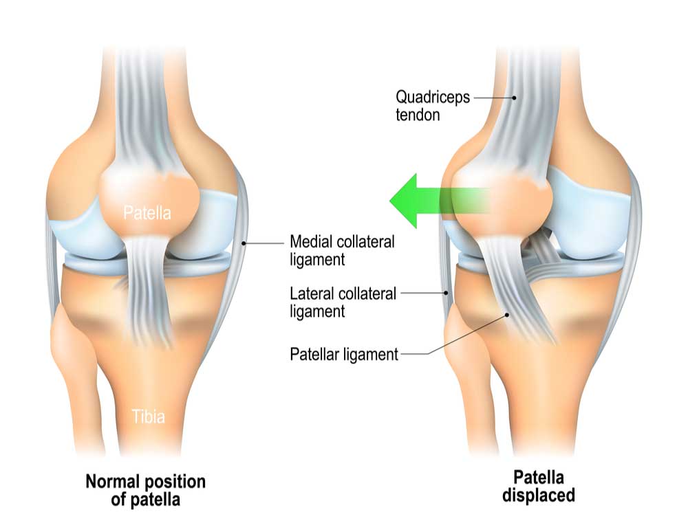 Kneecap slides deals to the side