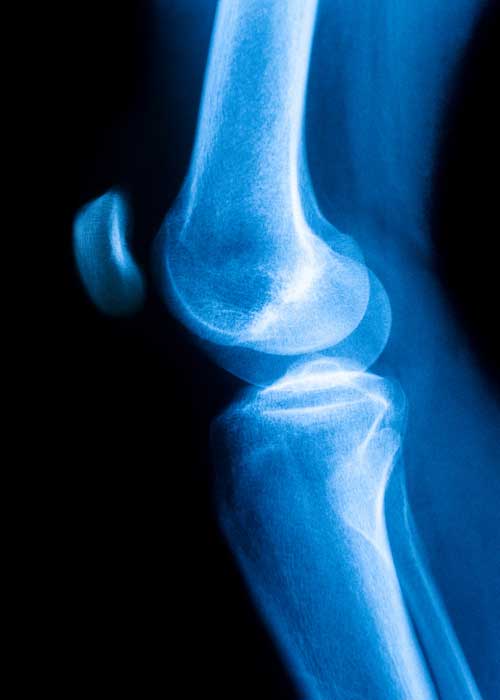 Patella