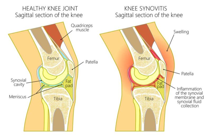 synovitis-of-the-knee-joint-inflammation-orthopedic-knee-specialist