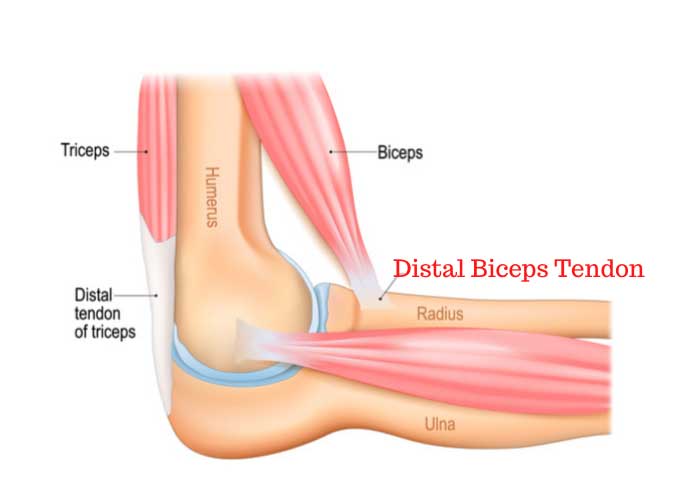 Distal Biceps Tendon Tear | Manhattan NY
