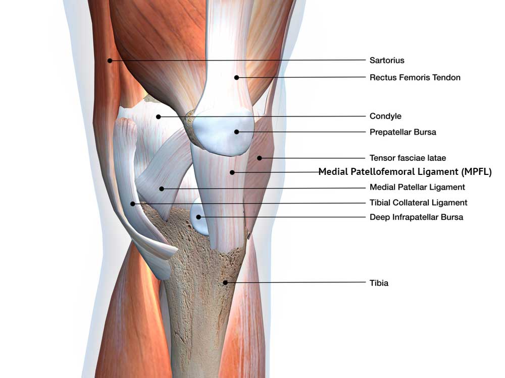 Medial Patellofemoral Ligament Injury, MPFL Tear, MPFL Insufficiency, Orthopedic Knee Specialist
