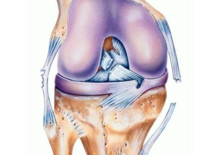 Multi-Ligament Knee Injury | Manhattan NY