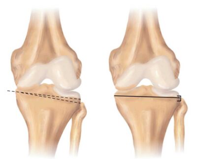 osteotomy knee tibial femoral distal tubercle
