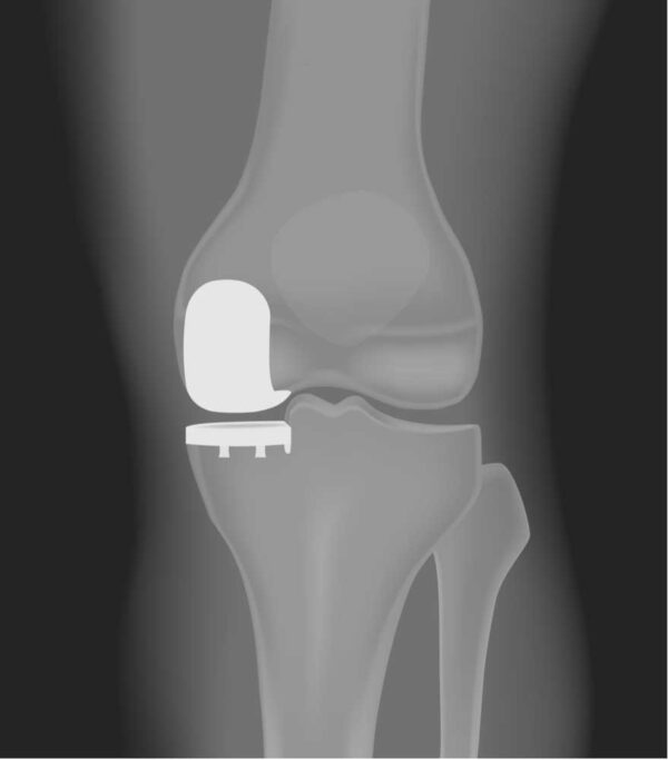 partial-knee-replacement-unicompartmental-arthroplasty-partial-knee