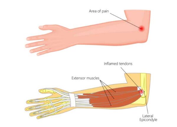 Lateral Epicondylitis Tennis Elbow Exercises