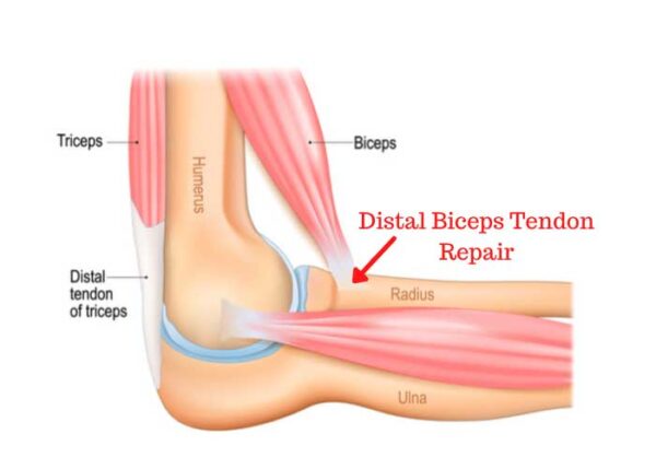 Distal Biceps Tendon Repair | Manhattan NY