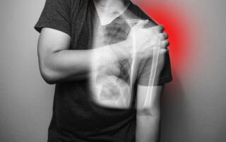 Subacromial Decompression | Manhattan NY
