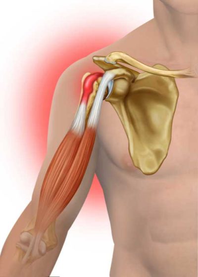 Can A Torn Bicep Tendon Heal Itself