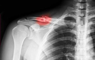 Clavicle Fracture | Manhattan NY