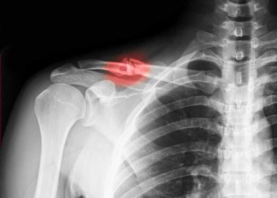 Clavicle Fracture | Manhattan NY