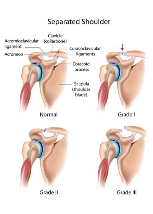 AC Joint Injury, Separated Shoulder, CC Joint Injury, Orthopedic Shoulder  Specialist