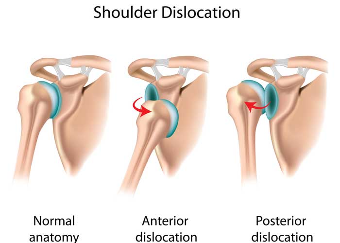 Shoulder Dislocation | Manhattan NY
