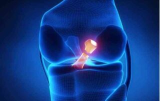 ACL Revision Surgery | Manhattan NY