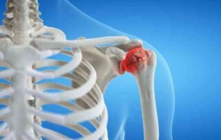 Shoulder Arthritis | Manhattan NY