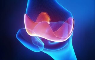 Osteochondral Allograft | Manhattan NY