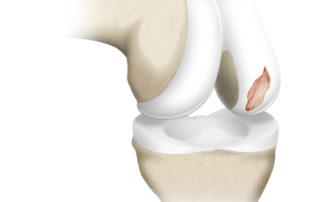 Knee Chondral Defect | Manhattan NY
