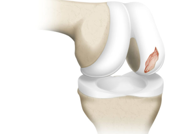 Cartilage Repair and Reconstruction | Orthopedic Knee Doctor ...