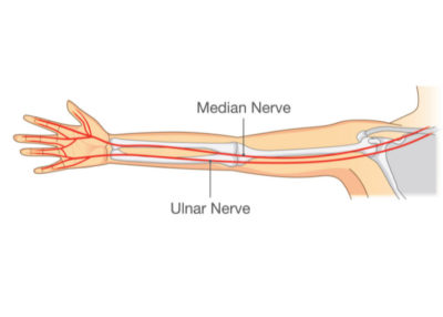 What is Ulnar Nerve Entrapment?