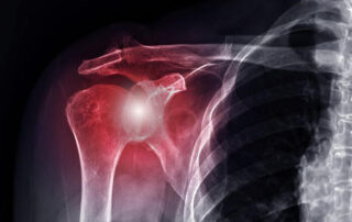 Shoulder Articular Cartilage | Manhattan NY