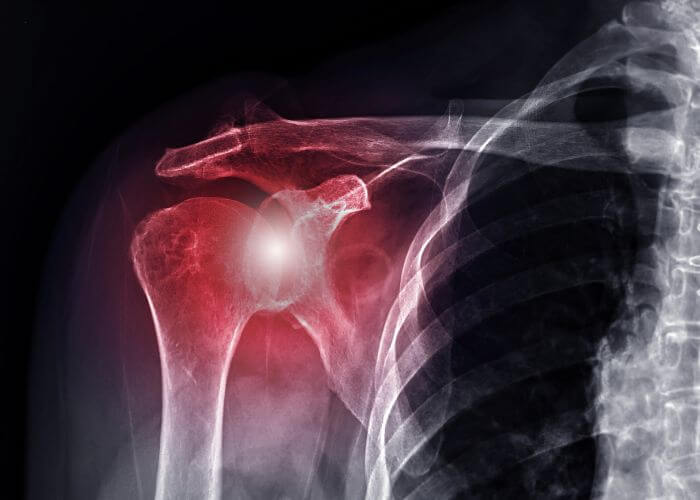 Shoulder Articular Cartilage | Manhattan NY