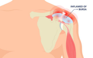 Shoulder Bursectomy | Manhattan NY