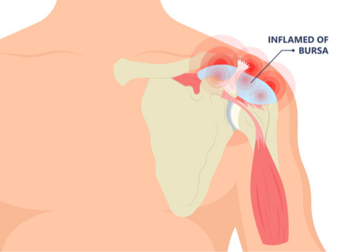 3 The bursa of the shoulder joint