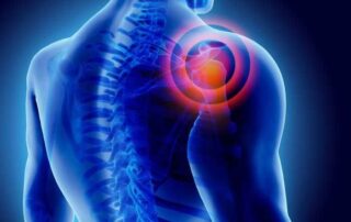 Shoulder Nerve Entrapment | Manhattan NY