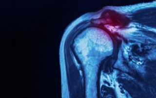 Labrum Tear | Manhattan NY