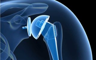 Shoulder Replacement | Manhattan NY