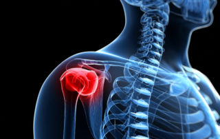 Shoulder Joint Resurfacing | Manhattan NY
