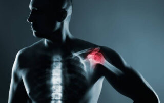 Suprascapular Nerve Entrapment | Manhattan NY