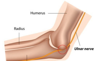 Ulnar Nerve Compression | Manhattan NY